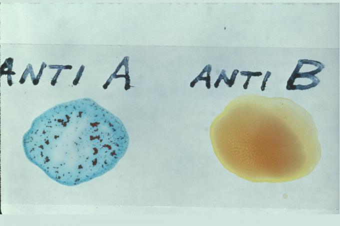 Agglutinazione di tipo A sangue